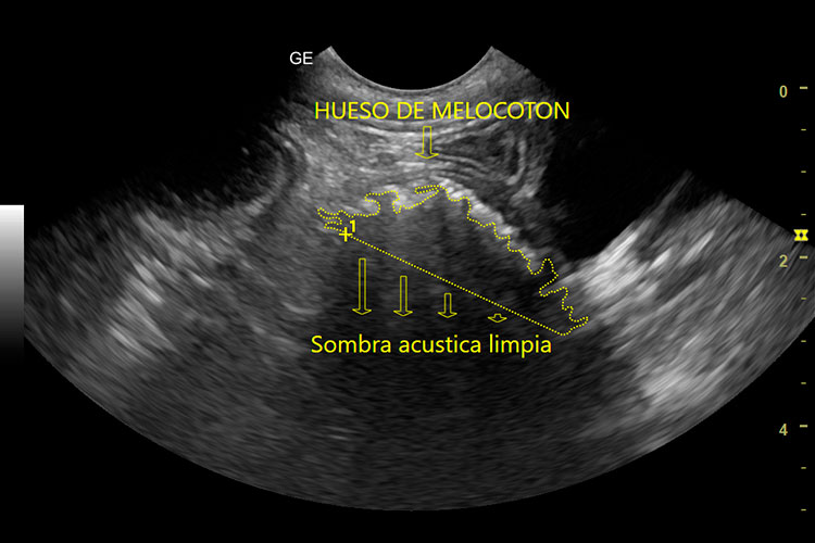 imágen ecográfica de cuerpo extraño intestinal en perro