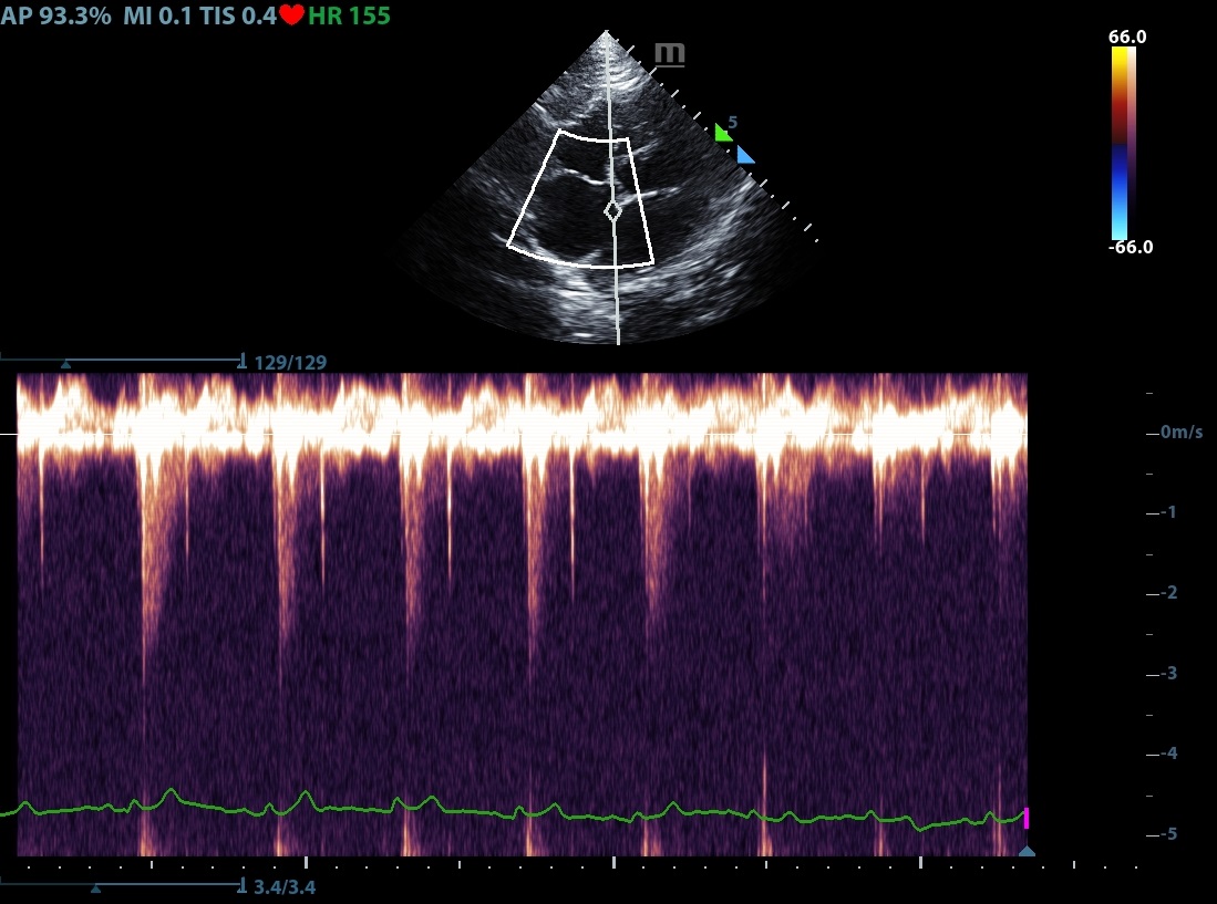 Imagen Doppler continuo de la insuficiencia tricúspide.